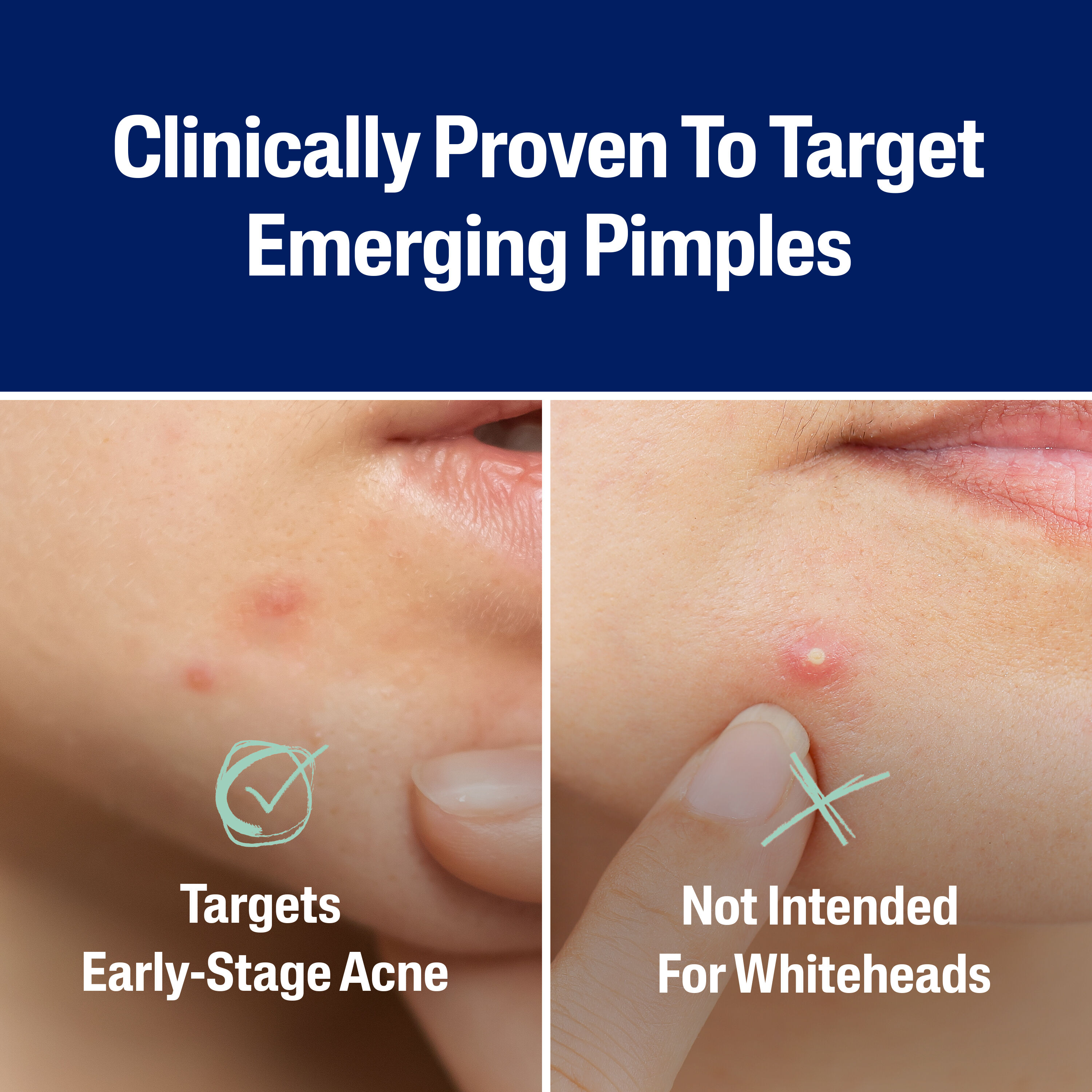 Fast Rescue Pimple Patch